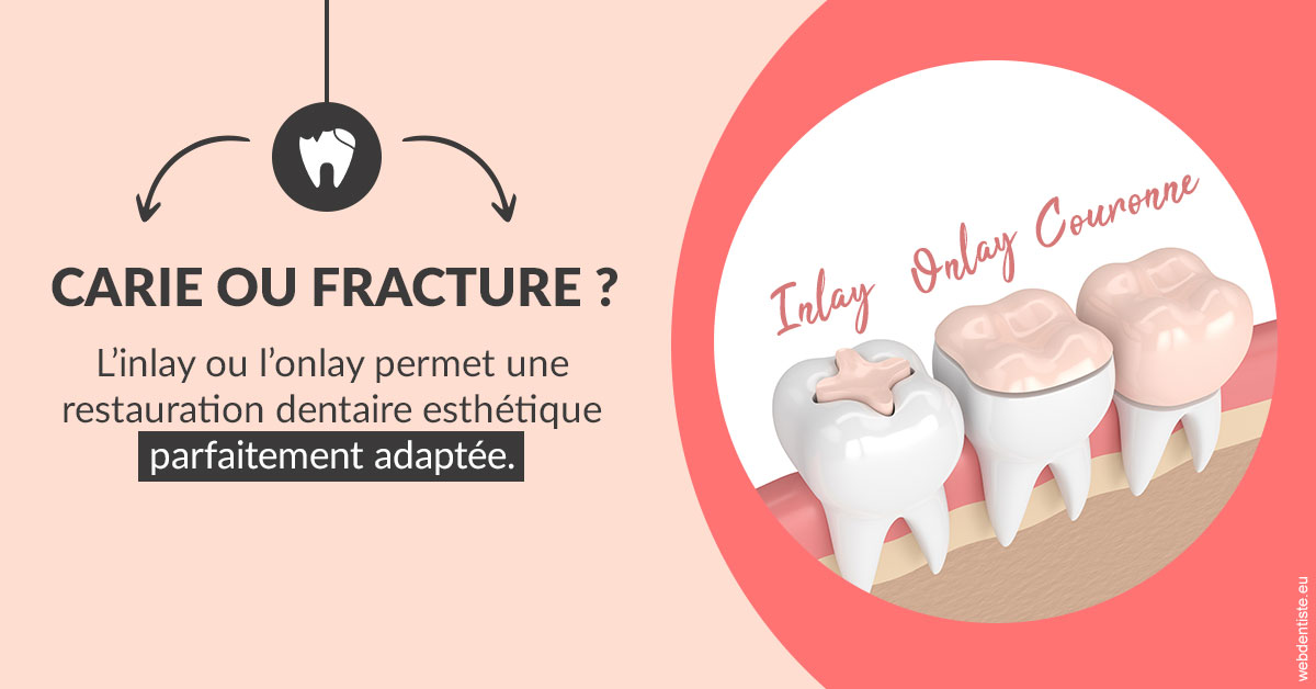 https://selarl-orthodontie-naborienne.chirurgiens-dentistes.fr/T2 2023 - Carie ou fracture 2