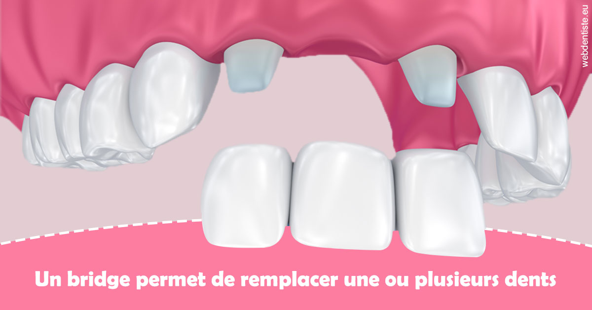 https://selarl-orthodontie-naborienne.chirurgiens-dentistes.fr/Bridge remplacer dents 2