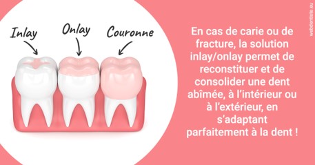 https://selarl-orthodontie-naborienne.chirurgiens-dentistes.fr/L'INLAY ou l'ONLAY 2