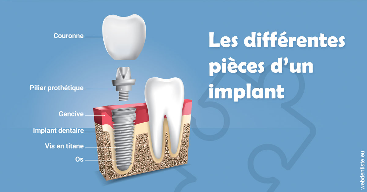 https://selarl-orthodontie-naborienne.chirurgiens-dentistes.fr/Les différentes pièces d’un implant 1