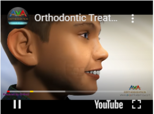 Orthodontic Treatment for Overjet